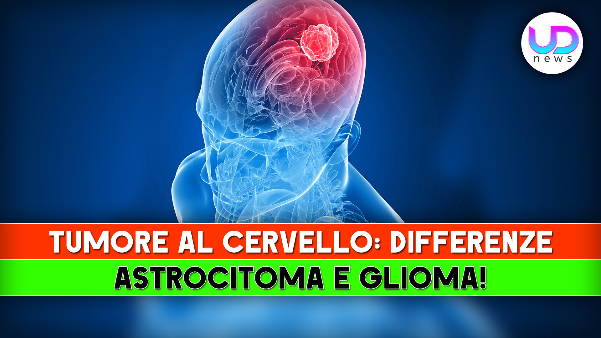 Tumore Al Cervello, Differenze: Ecco Cosa Cambia Tra Astrocitoma E Glioma! Tumore Al Cervello, Differenze: Ecco Cosa Cambia Tra Astrocitoma E Glioma!